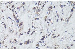 Immunohistochemistry of paraffin-embedded Human gastric cancer using TrkB Polyclonal Antibody at dilution of 1:200 (40x lens). (TRKB anticorps)