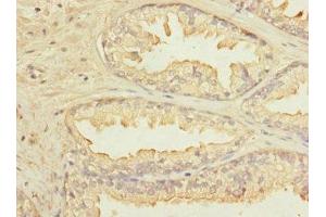 Immunohistochemistry of paraffin-embedded human prostate cancer using ABIN7157271 at dilution of 1:100 (KLHL13 anticorps  (AA 1-260))