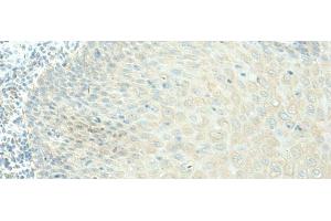 Immunohistochemistry of paraffin-embedded Human esophagus cancer tissue using EVI2B Polyclonal Antibody at dilution of 1:40(x200) (EVI2B anticorps)