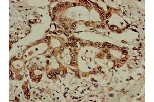 Immunohistochemistry of paraffin-embedded human pancreatic cancer using ABIN7152172 at dilution of 1:100