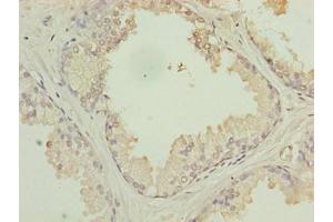 Immunohistochemistry of paraffin-embedded human prostate cancer using ABIN7175441 at dilution of 1:100 (PTPLB anticorps  (AA 7-41))