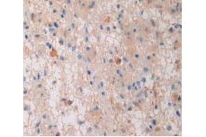 IHC-P analysis of Human Glioma Tissue, with DAB staining. (PZP anticorps  (AA 1212-1391))