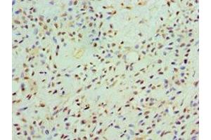 Immunohistochemistry of paraffin-embedded human breast cancer using ABIN7146438 at dilution of 1:100