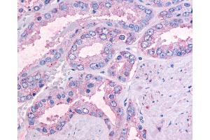 Anti-OR51E1 antibody IHC of human Prostate, Carcinoma. (OR51E1 anticorps  (Cytoplasmic Domain))
