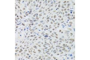 Immunohistochemistry of paraffin-embedded human lung cancer using DDB1 Antibody. (DDB1 anticorps)