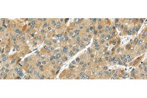 Immunohistochemistry of paraffin-embedded Human liver cancer using TMPRSS11D Polyclonal Antibody at dilution of 1/35 (TMPRSS11D anticorps)