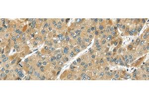 Immunohistochemistry of paraffin-embedded Human liver cancer using TMPRSS11D Polyclonal Antibody at dilution of 1/35 (TMPRSS11D anticorps)