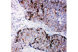 Anti-TIMP2 antibody, IHC(P) IHC(P): Human Mammary Cancer Tissue (TIMP2 anticorps  (C-Term))