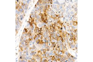Immunohistochemistry of paraffin-embedded Human esophageal cancer using  antibody (ABIN7265531) at dilution of 400(40x lens).
