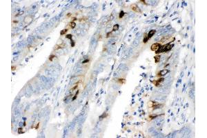 ITLN1 was detected in paraffin-embedded sections of human intestinal cancer tissues using rabbit anti- ITLN1 Antigen Affinity purified polyclonal antibody (Catalog # ) at 1 µg/mL.
