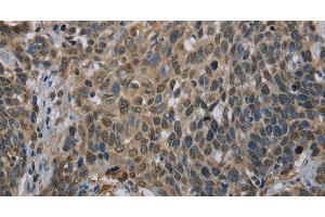 Immunohistochemistry of paraffin-embedded Human cervical cancer using UBP1 Polyclonal Antibody at dilution of 1:40 (UBP1 anticorps)