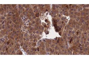 ABIN6277173 at 1/100 staining Human liver cancer tissue by IHC-P.