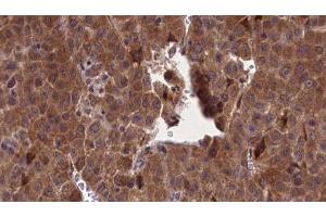 ABIN6277173 at 1/100 staining Human liver cancer tissue by IHC-P. (Selectin E/CD62e anticorps  (N-Term))