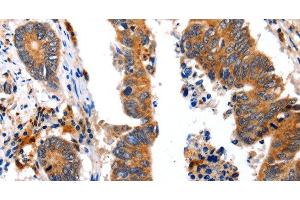 Immunohistochemistry of paraffin-embedded Human colon cancer using NCK1 Polyclonal Antibody at dilution of 1:30 (NCK1 anticorps)
