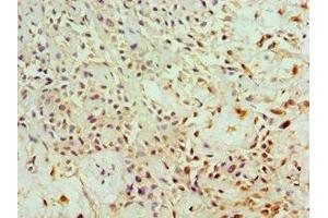 Immunohistochemistry of paraffin-embedded human breast cancer using ABIN7144280 at dilution of 1:100