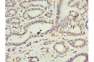 Immunohistochemistry of paraffin-embedded human breast cancer using ABIN7149554 at dilution of 1:100 (DAPK2 anticorps  (AA 222-370))