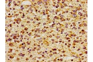 Immunohistochemistry of paraffin-embedded human glioma using ABIN7156468 at dilution of 1:100