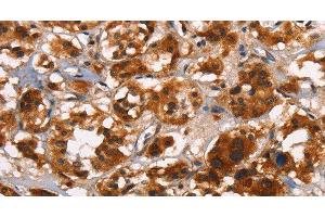 Immunohistochemistry of paraffin-embedded Human thyroid cancer tissue using ATRN Polyclonal Antibody at dilution 1:50 (Attractin anticorps)