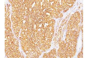 Formalin-fixed, paraffin-embedded human Renal Cell Carcinoma stained with RCC Monoclonal Antibody (SPM487). (CA9 anticorps)