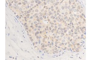 ABIN6267284 at 1/100 staining human tongue cancer tissue sections by IHC-P.