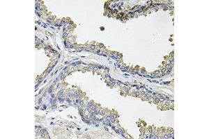 Immunohistochemistry of paraffin-embedded human prostate using ACO1 antibody at dilution of 1:100 (x40 lens). (Aconitase 1 anticorps)