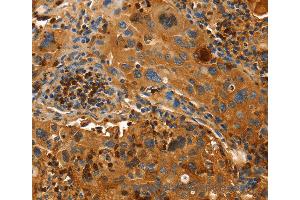 Immunohistochemistry of Human lung cancer using ORM2 Polyclonal Antibody at dilution of 1:50