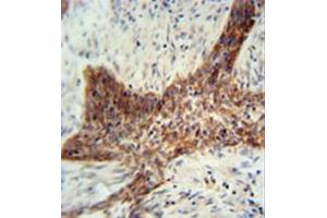 Formalin fixed, paraffin embedded human lung carcinoma stained with RILPL2 Antibody (Center) followed by peroxidase conjugation of the secondary antibody and DAB staining. (RILPL2 anticorps  (Middle Region))