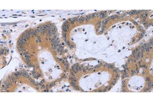 Immunohistochemistry of paraffin-embedded Human colon cancer using MAPRE3 Polyclonal Antibody at dilution of 1:30 (ECE1 anticorps)