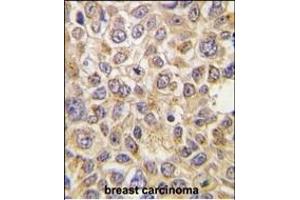 Formalin-fixed and paraffin-embedded human breast carcinoma tissue reacted with AT(Slc29a4) Antibody (N-term) (ABIN387943 and ABIN2844504) , which was peroxidase-conjugated to the secondary antibody, followed by DAB staining.