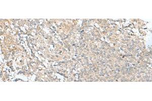 Immunohistochemistry of paraffin-embedded Human tonsil tissue using SLC26A3 Polyclonal Antibody at dilution of 1:35(x200)