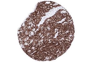 Parathyroid Parathyroid gland showing intense cytoplasmic PTH immunostaining of all glandular cells