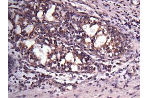 IHC-P Image Immunohistochemical analysis of paraffin-embedded human breast cancer, using VAPA, antibody at 1:500 dilution.