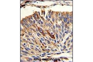 Formalin-fixed and paraffin-embedded human lung carcinoma with VTI1A Antibody (C-term), which was peroxidase-conjugated to the secondary antibody, followed by DAB staining.