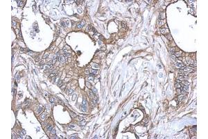 IHC-P Image Immunohistochemical analysis of paraffin-embedded human gastric cancer, using S100A10, antibody at 1:500 dilution. (S100A10 anticorps)