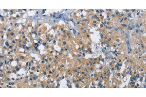 Immunohistochemistry of paraffin-embedded Human thyroid cancer tissue using BMPR1B Polyclonal Antibody at dilution 1:30 (BMPR1B anticorps)