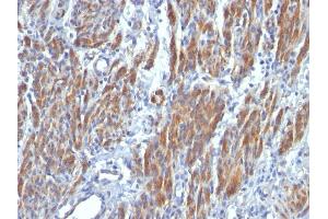 Formalin-fixed, paraffin-embedded human Leiomyosarcoma stained with SM-MHC Monoclonal Antibody (SMMS-1). (MYH11 anticorps)