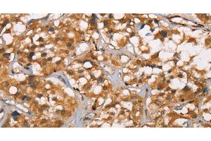 Immunohistochemistry of paraffin-embedded Human thyroid cancer tissue using DICER1 Polyclonal Antibody at dilution 1:40 (DICER1 anticorps)