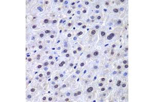 Immunohistochemistry of paraffin-embedded human liver injury using APEX1 antibody. (APEX1 anticorps  (AA 1-318))