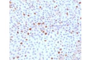 IHC testing of FFPE human bladder carcinoma with TOP2A antibody (clone TPM2A-1). (Topoisomerase II alpha anticorps)