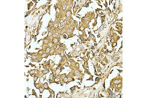 Immunohistochemistry of paraffin-embedded Human breast cancer using CE antibody (ABIN7266084) at dilution of 100 (40x lens).