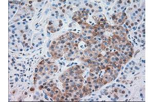 Immunohistochemical staining of paraffin-embedded Carcinoma of kidney tissue using anti-SERPINA1mouse monoclonal antibody. (SERPINA1 anticorps)