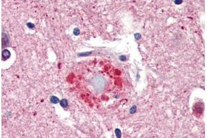 Human Brain, Cortex, Senile Plaque (formalin-fixed, paraffin-embedded) stained with Ubiquitin antibody ABIN462097 at 10 ug/ml followed by biotinylated goat anti-rabbit IgG secondary antibody ABIN481713, alkaline phosphatase-streptavidin and chromogen. (Ubiquitin anticorps)