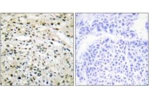 Immunohistochemistry analysis of paraffin-embedded human liver carcinoma tissue, using DNMT3B Antibody. (DNMT3B anticorps  (AA 1-50))
