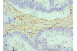 Immunohistochemistry of paraffin-embedded human colon cancer using ABIN7146462 at dilution of 1:100