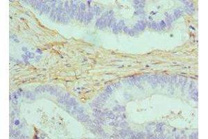 Immunohistochemistry of paraffin-embedded human colon cancer using ABIN7146462 at dilution of 1:100