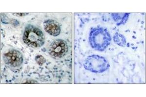 Immunohistochemistry analysis of paraffin-embedded human breast carcinoma tissue, using GAP43 (Ab-41) Antibody. (GAP43 anticorps  (AA 8-57))