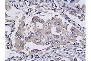 Formalin-fixed and paraffin embedded human colon cancer labeled with Anti-TRAILR2/DR5/CD262 Polyclonal Antibody, Unconjugated (ABIN733118) followed by conjugation to the secondary antibody and DAB staining (TNFRSF10B anticorps  (AA 301-381))