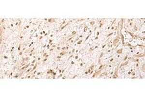 Immunohistochemistry of paraffin-embedded Human ovarian cancer tissue using RRP1 Polyclonal Antibody at dilution of 1:45(x200) (RRP1 anticorps)