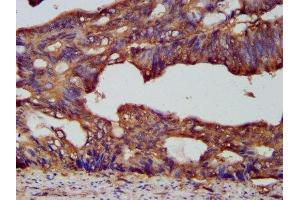 IHC image of ABIN7164828 diluted at 1:200 and staining in paraffin-embedded human colon cancer performed on a Leica BondTM system. (PCSK7 anticorps  (AA 189-362))