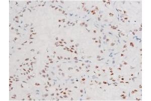 ABIN6267578 at 1/200 staining Human lung cancer tissue sections by IHC-P.